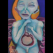 "Gastroschisis"
